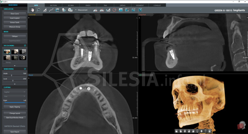 RTG i tomografia CBCT od 100 zł – Świętochłowice